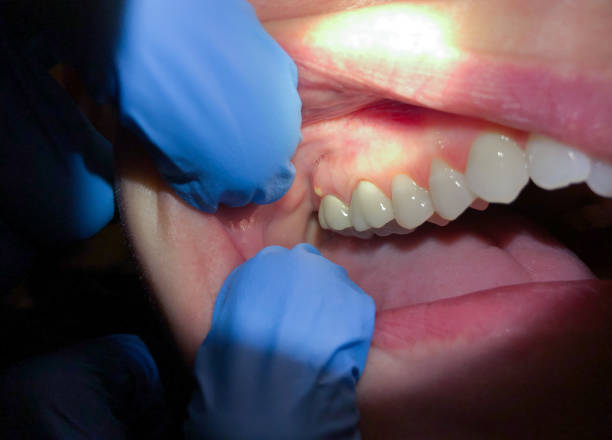 Best Emergency Wisdom Teeth Removal in Conway, PA